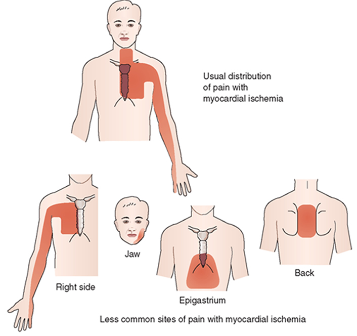 Причины боли сердца у мужчин. Болевые зоны при инфаркте миокарда. Инфаркт миокарда локализация боли. Локализация боли при инфаркте миокарда. Локализация боли в груди.