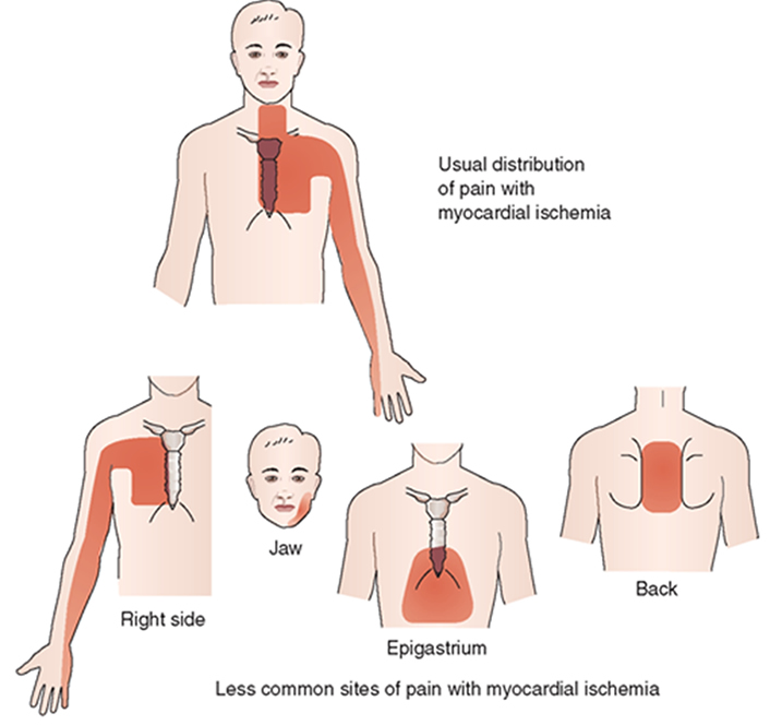 Боли при ишемии. Болевые зоны при инфаркте миокарда. Инфаркт миокарда локализация боли. Локализация боли при инфаркте миокарда. Локализация боли в груди.